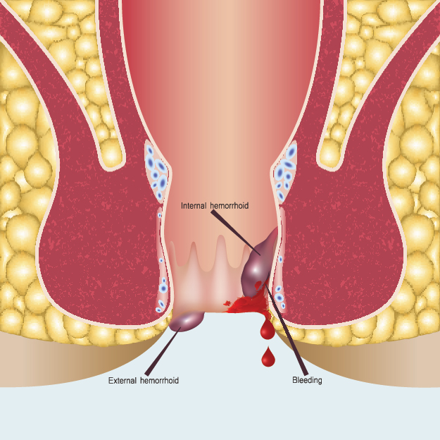 hemorrhoids treatment